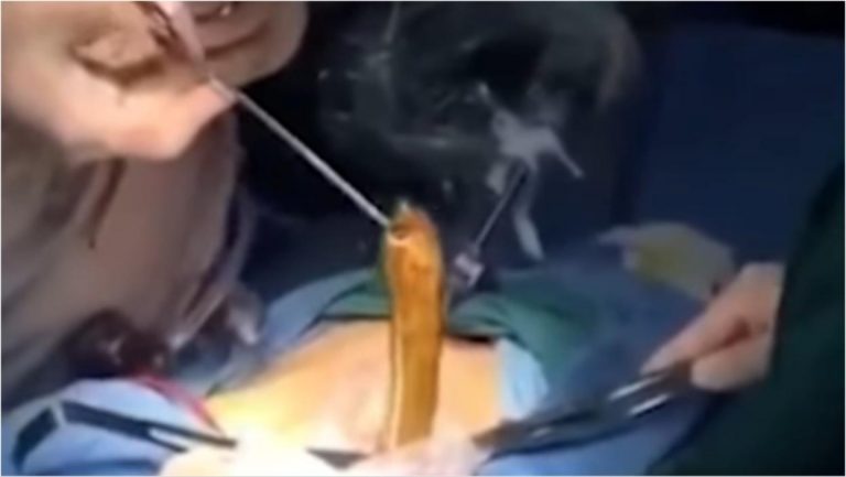KAKO JE OVO MOGUĆE?! Čoveku u stomaku pronašli zalutalo BIĆE, doktori ostali u ŠOKU kada im se pred očima stvorila ONA (VIDEO)