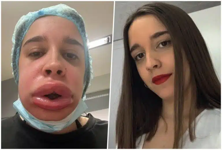 “Otišla sam da uklonim filere iz usana, sad me zovu žaba krastača” Sara zbog estetske korekcije prošla horor, pa završila u bolnici (FOTO)